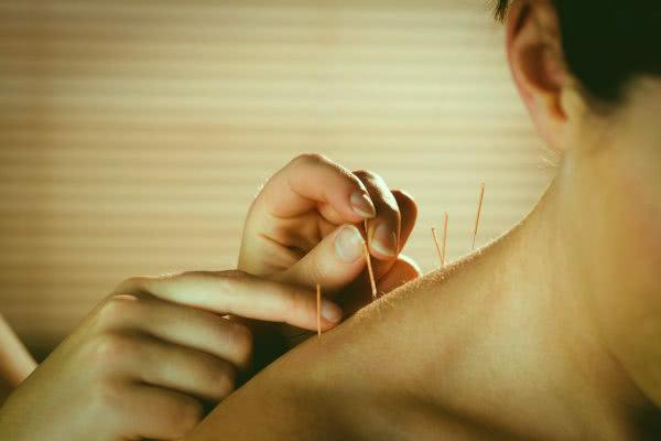 129 akupunktur 600x400 1